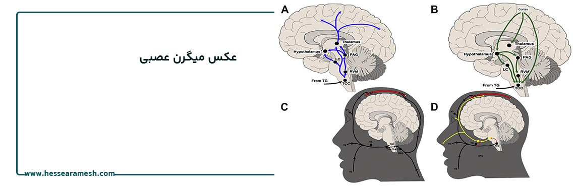 عکس میگرن عصبی